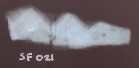 An X-ray image showing an iron band with crown-like triangular protrusions on one side.