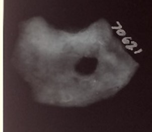 A photograph of an X-ray of find 70621, revealing a round hole in the centre right of the object.