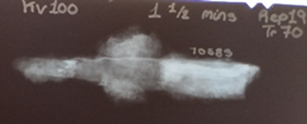 A photograph of an X-ray of find 70583. The tapering end of the object is dark grey; the broader end is pale grey, almost white. Clouds of dull grey material surround the wider end of the dark grey section of the object. 