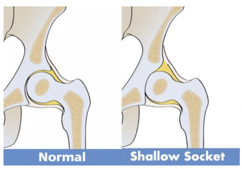 Hip Dysplasia Normal vs Shallow Sockets [images from the International Hip Dysplasia Institute https://hipdysplasia.org/]