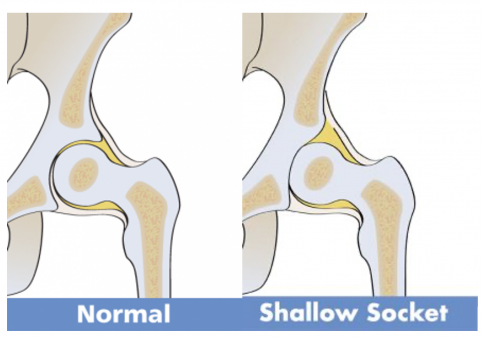 What is hip outlet dysplasia