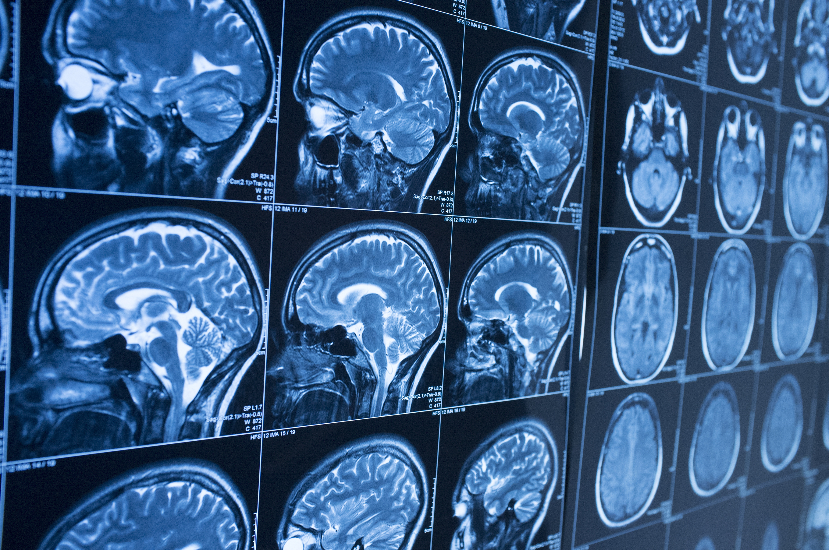 Increasing mental health awareness in Huntington’s Disease