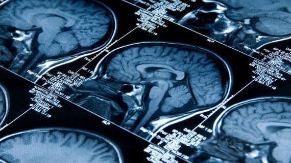 Is schizophrenia an autoimmune disease?